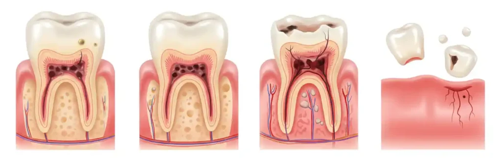 What to do When a Rotten Tooth Falls Out - Why fall